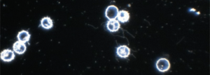 Borreliose